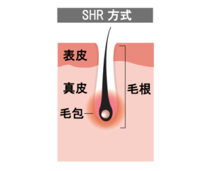 SHR脱毛方式の説明図